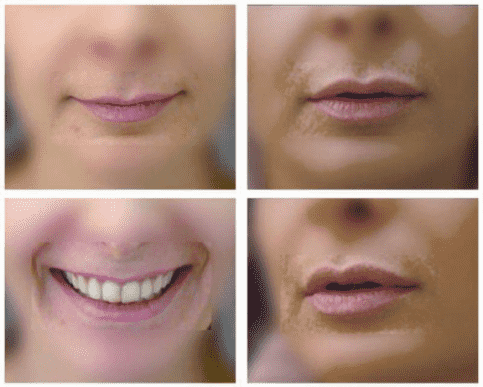 Arcplasztika vagy botox